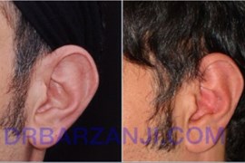 عمل جراحی پلاستیک برجستگی لاله گوش