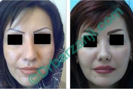 جراحی پلاستیک بینی هفت سال بعد از عمل
