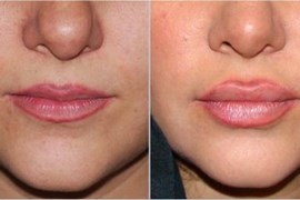 تزریق ژل جوویدرم در لب 