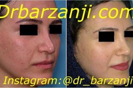 جراحی ترمیمی بینی چهار ماه بعد از عمل