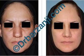 عمل جراحی پلاستیک بینی چهار سال بعد