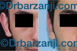جراحی ترمیمی برجستگی لاله گوش