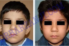 جراحی پلاستیک ناهنجاری لاله گوش راست