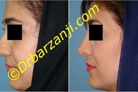 جراحی  زیبایی بینی 