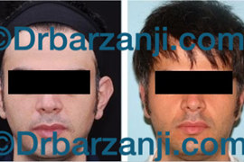 عمل جراحی پلاستیک برجستگی لاله گوش