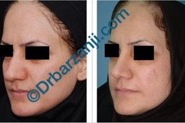 عمل جراحی پلاستیک بینی چهار سال بعد