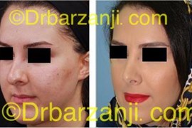 عمل جراحی زیبایی بینی یک سال بعد