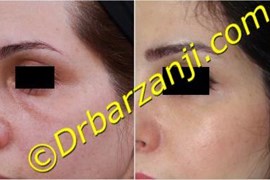 تزریق چربی زیر چشم ( ناودان اشکی )