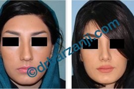 جراحی بینی یک سال و نیم بعد از عمل