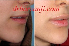 تزریق فیلر ژوویدرم در لب