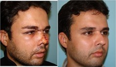 پارگی و شکستگی بینی 4