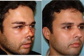 پارگی و شکستگی بینی 4