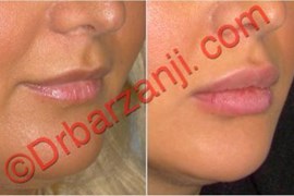 تزریق ژل جوویدرم  ( ژوویدرم ) به لب پانزده ماه بعد
