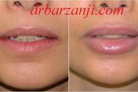 تزریق ژل جوویدرم در لب