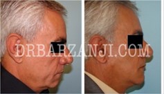 فیس لیفت و پروتز چانه