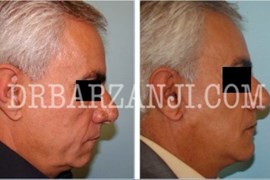 فیس لیفت و پروتز چانه