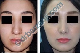  جراحی پلاستیک بینی یک سال بعد از عمل