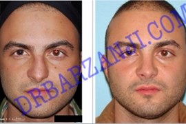 عمل جراحی پلاستیک بینی ٢ سال بعد