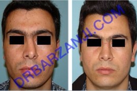 جراحی بینی، شش ماه بعد از عمل