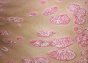 پسوریازیس خطر ابتلا به سکته مغزی و نامنظم شدن ضربان قلب را افزایش می دهد