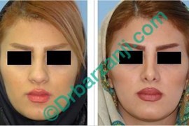 جراحی پلاستیک بینی شش ماه بعد از عمل