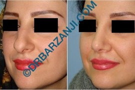 جراحی بینی یک سال بعد از عمل
