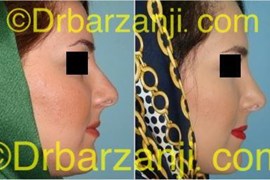عمل جراحی زیبایی بینی یک سال بعد