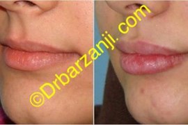 تزریق ژل ژوویدرم به لب
