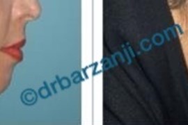 عمل جراحی پروتز چانه