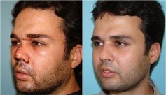 پارگی و شکستگی بینی 5