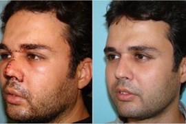 پارگی و شکستگی بینی 5