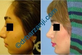  جراحی بینی و پروتز چانه چهار سال بعد از عمل