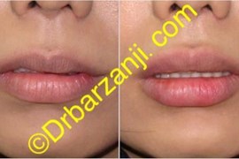 تزریق ژل ژوویدرم به لب