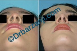 جراحی پلاستیک بینی نه ماه بعد از عمل
