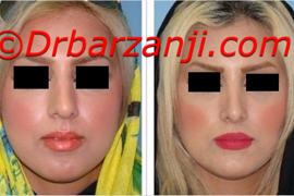 جراحی بینی و پروتز چانه و گونه شش ماه بعد