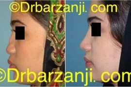جراحی پلاستیک با پیوند غضروف دنده به بینی