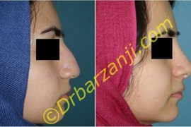 جراحی بینی گوشتی یک سال بعد از عمل