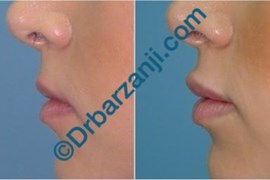 تزریق ژل جوویدرم  ( ژوویدرم ) به لب
