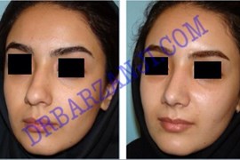 جراحی بینی ، ٣ ماه بعد از عمل