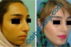  جراحی بینی و پروتز چانه چهار سال بعد از عمل