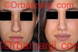 عکس عمل جراحی پلاستیک بینی ۶ ماه بعد
