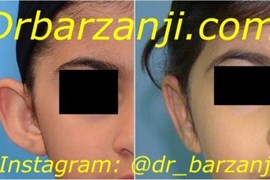 جراحی زیبایی لاله گوش برجسته