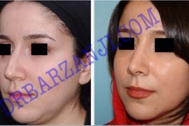 جراحی بینی،۶ ماه بعد از عمل
