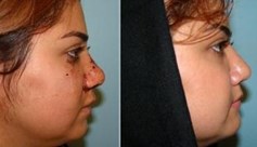 پارگی و شکستگی بینی 6
