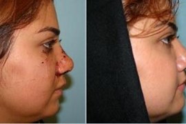 پارگی و شکستگی بینی 6