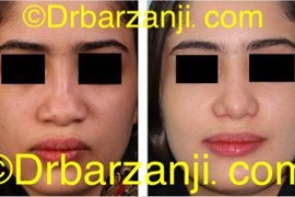 جراحی پلاستیک با پیوند غضروف دنده به بینی
