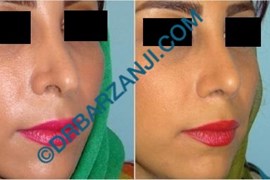 جراحی ثانویه بینی، ترمیم فرورفتگی و بالاکشیدگی پره بینی