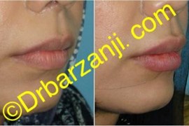 تزریق ژل ژوویدرم به لب