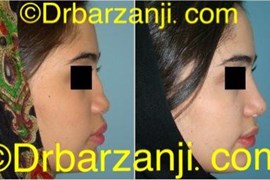 جراحی پلاستیک با پیوند غضروف دنده به بینی