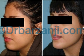 پروتز چانه و لیپوساکشن غبغب یک سال و نیم بعد